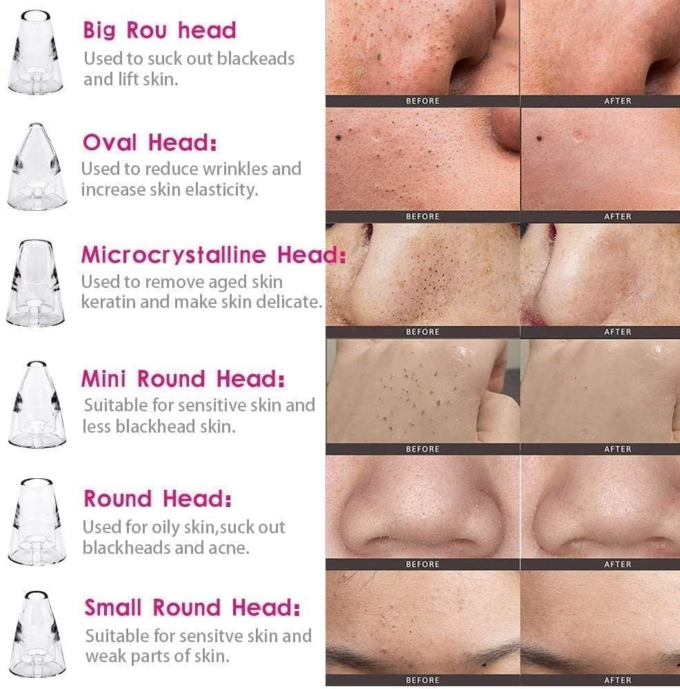 Remove Blackhead Device